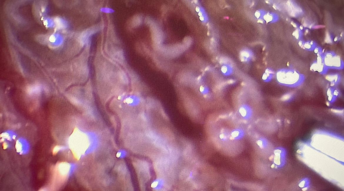 Síndrome de Klinefelter y fertilidad. ¿Cuándo nos rendimos?